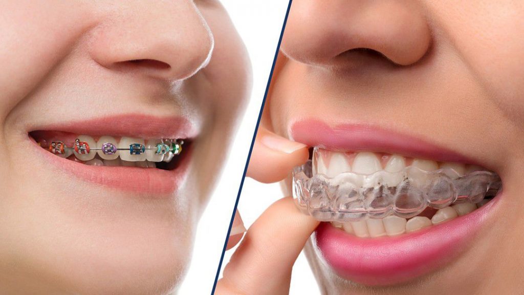 The Fascinating History of Clear Aligners