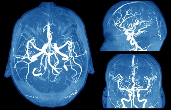 Understanding Aneurysms: A Comprehensive Guide to Causes, Symptoms, and Treatment